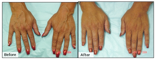 AVC Before After Hands