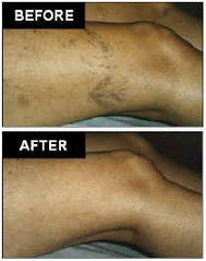 AVC Before After Spider Veins1