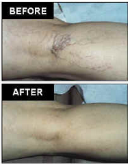 AVC Before After Spider Veins2