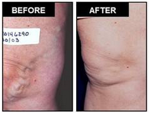AVC Before After Varicose Veins1