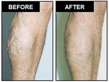 AVC Before After Varicose Veins2