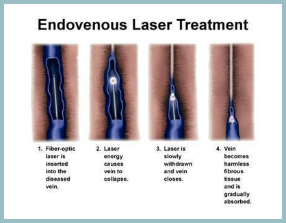 AVC Endovenous Laser Treatment