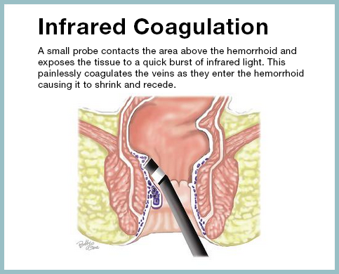 AVC Hemorrhoid Treatments Infrared Coag