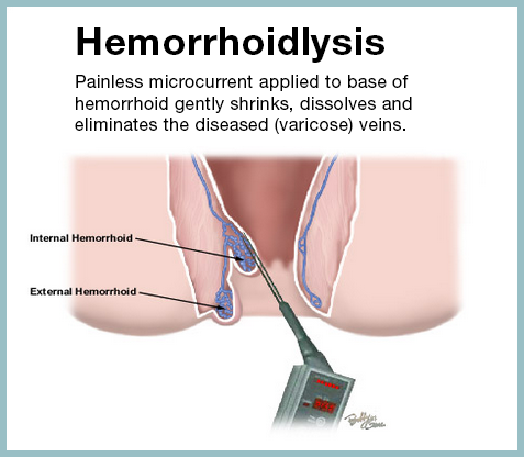 AVC Hemorrhoid treatments Hemorrhoidlysis