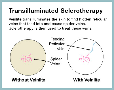 AVC TransilluminatedSclerotherapy VEINLITE